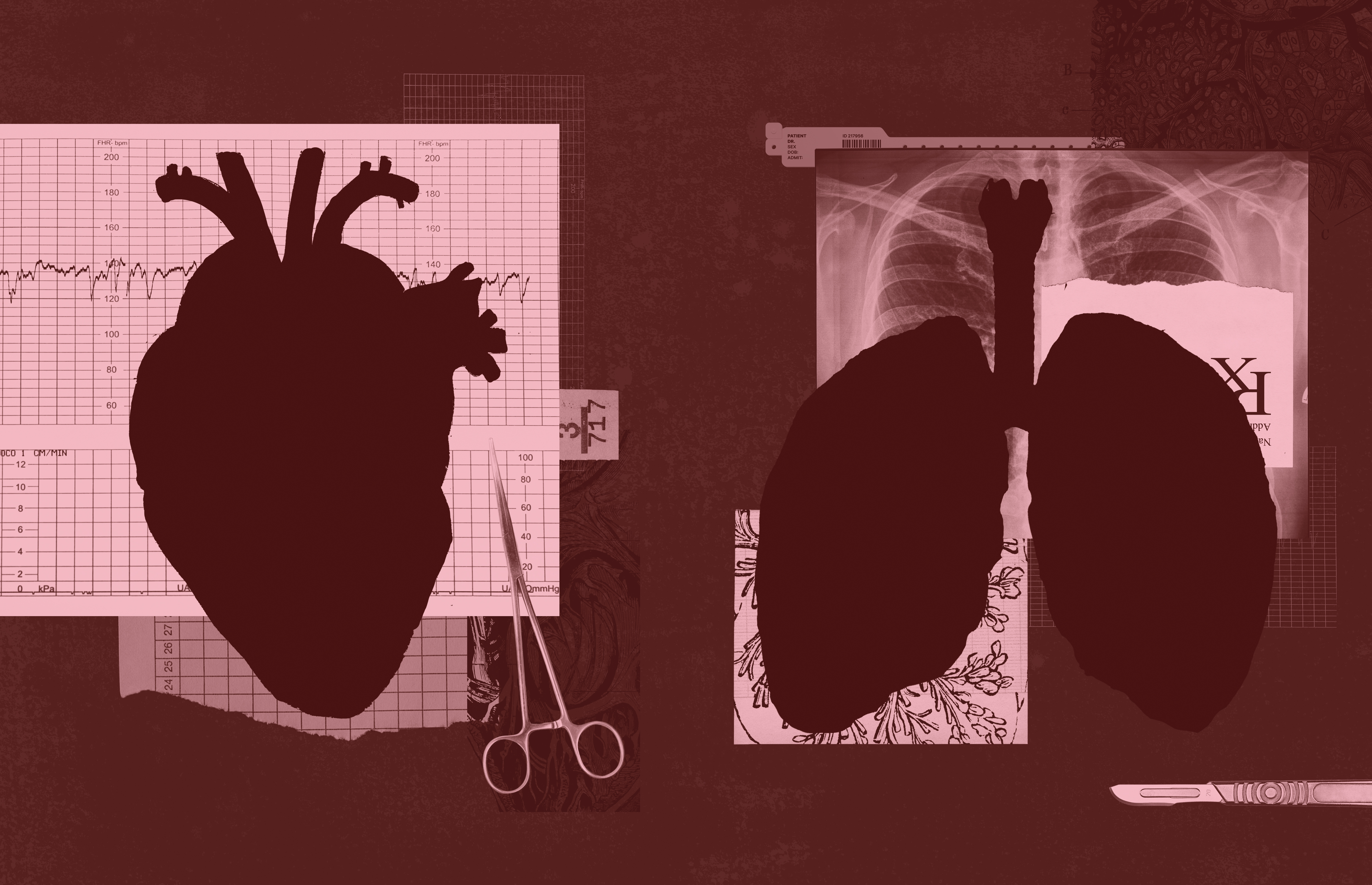 How Cleveland Became the Last-Chance Capital for Heart and Lung Transplant Patients