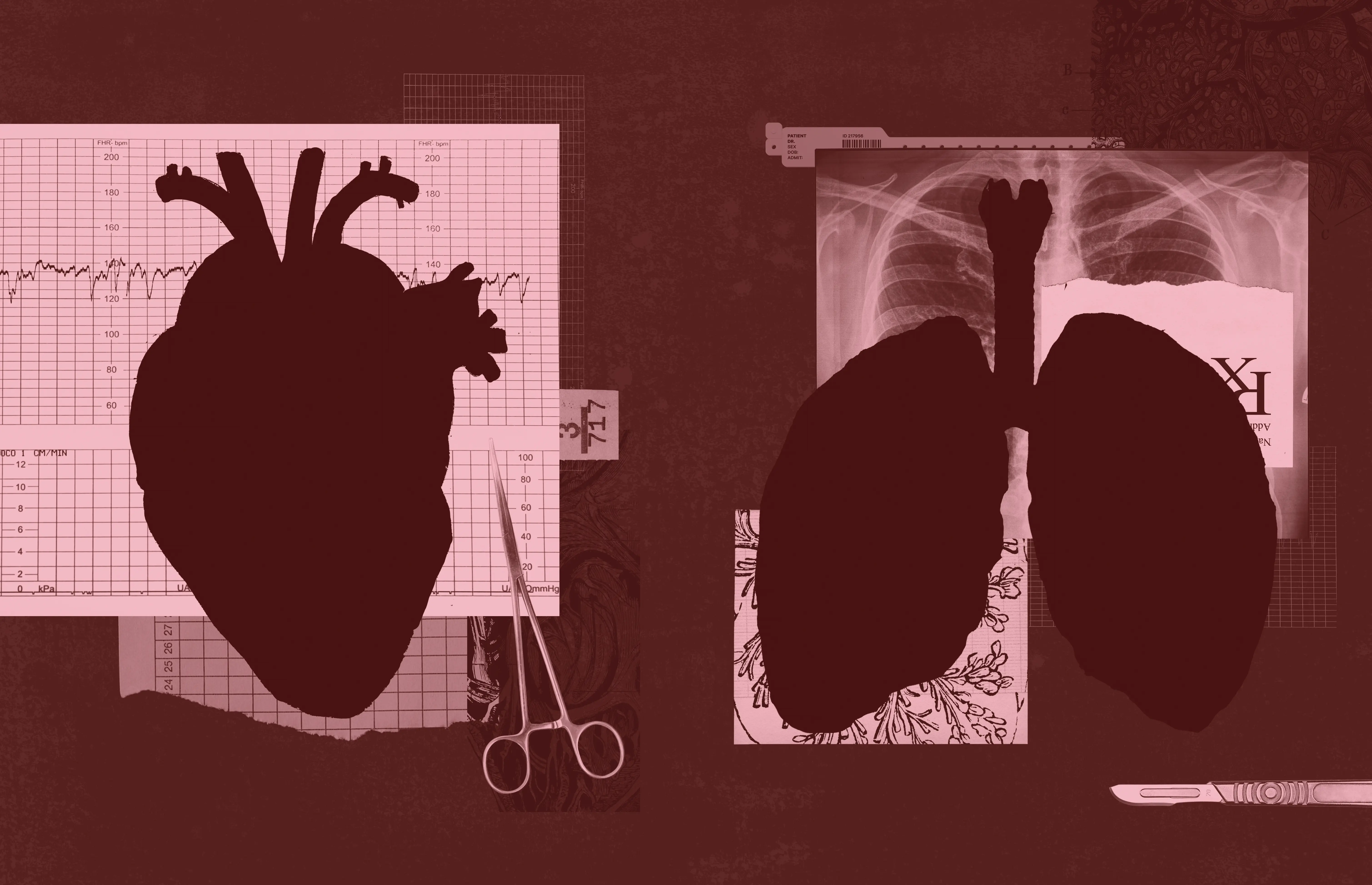 How Cleveland Became the Last-Chance Capital for Heart and Lung Transplant Patients