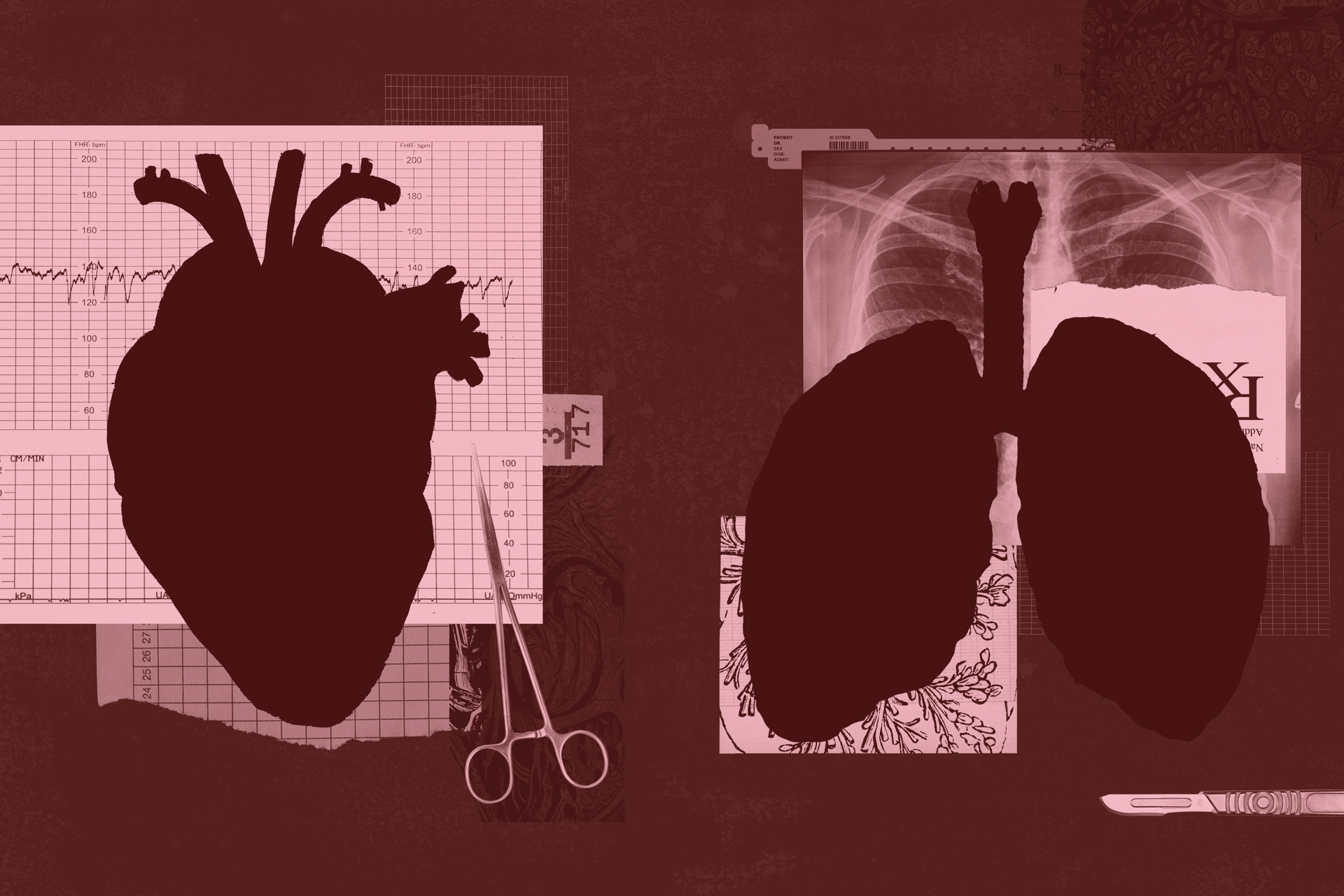 How Cleveland Became the Last-Chance Capital for Heart and Lung Transplant Patients